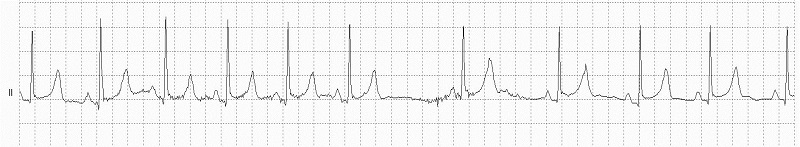 2° SA Block Rhythm Strip